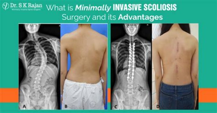 Ultimate Guide To Scar Scoliosis Surgery: Healing And Recovery