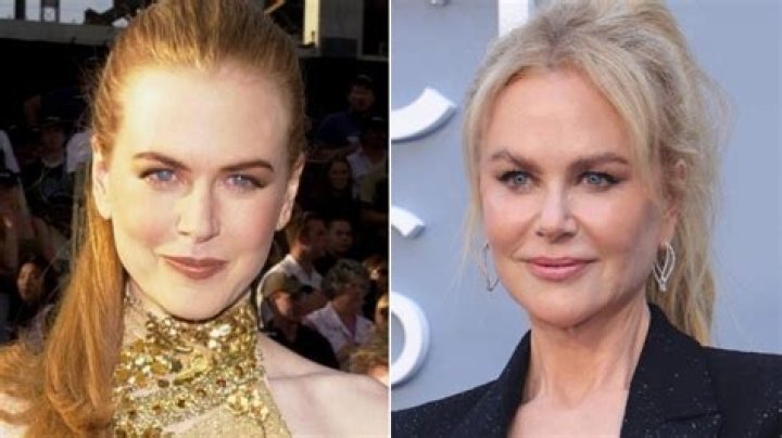 Unmasking The Transformation: Nicole Kidman's Journey With Plastic Surgery
