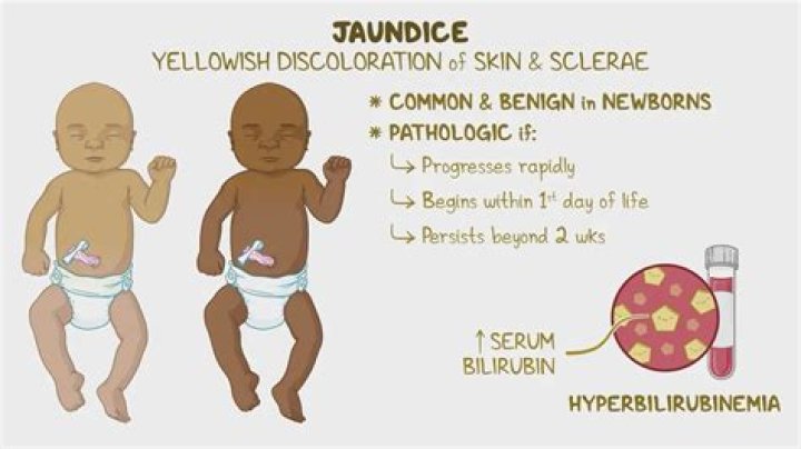 Unveiling The Enigma Of "Chris Rock Jaundice": A Treasure Trove Of Medical Insights