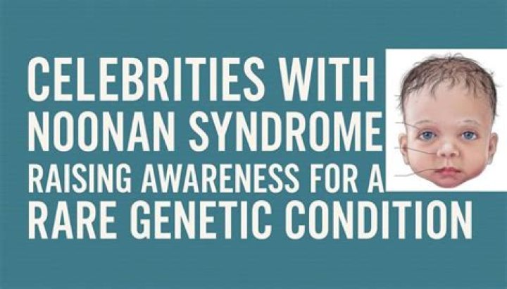 Unveiling The Faces Of Noonan Syndrome: Celebrities With The Rare Genetic Disorder